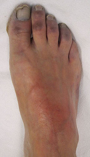 English: Vascular of the toes with the charact...